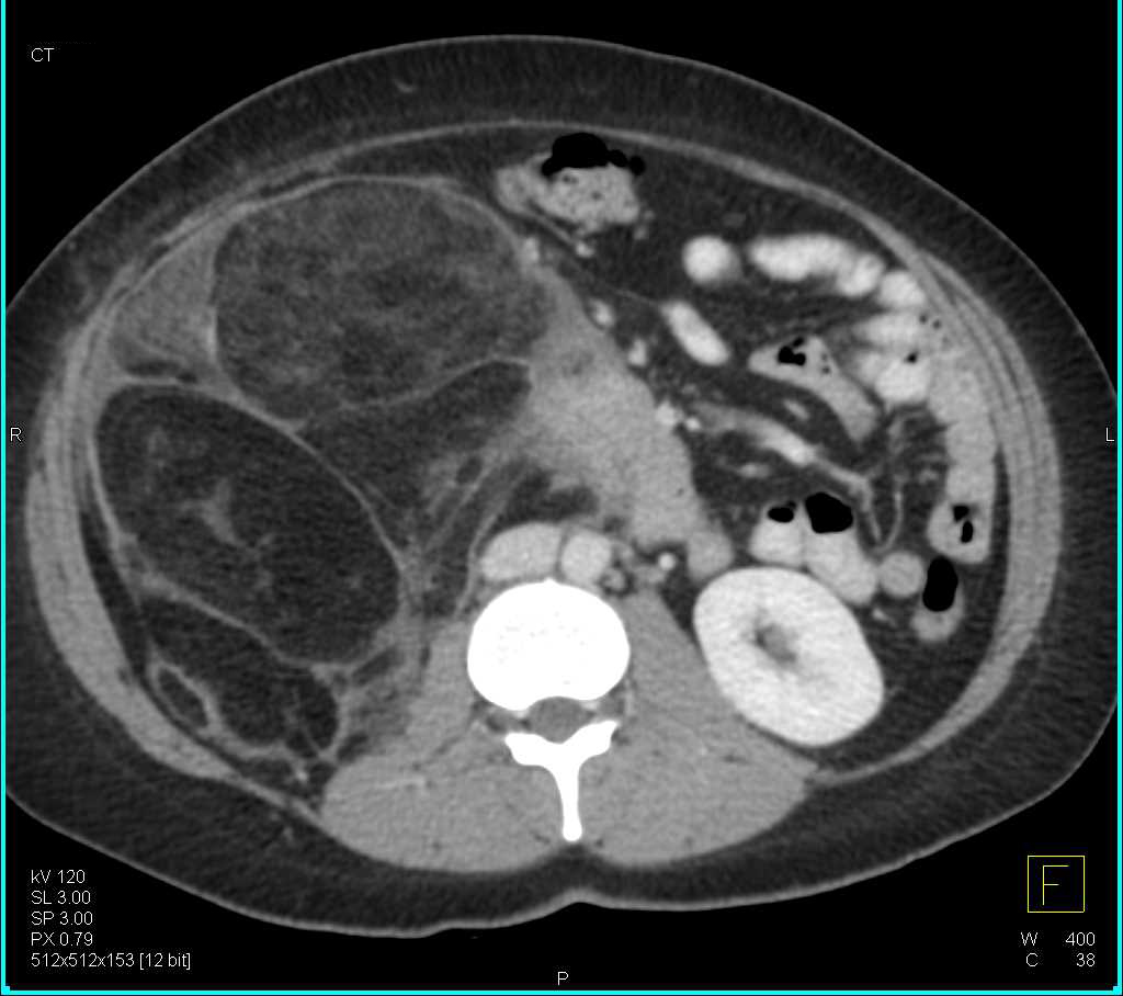 Retroperitoneal Liposarcoma - CTisus CT Scan