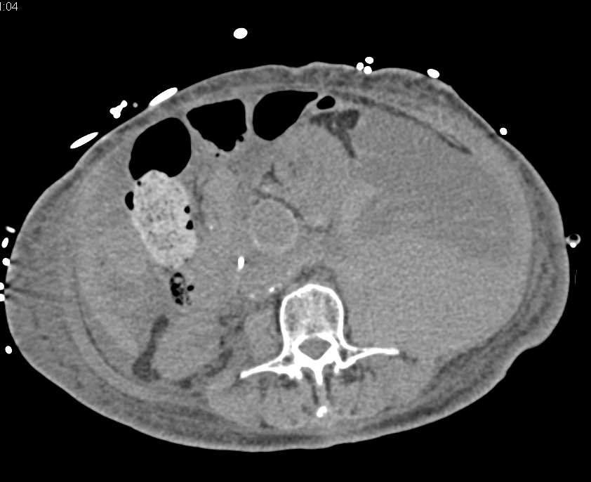 Large Left Lower Quadrant Bleed - CTisus CT Scan