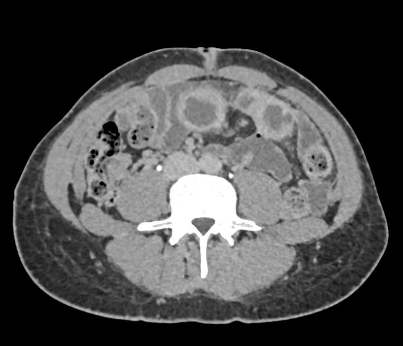 Thickening Small Bowel due to Infectious Enteritis - CTisus CT Scan