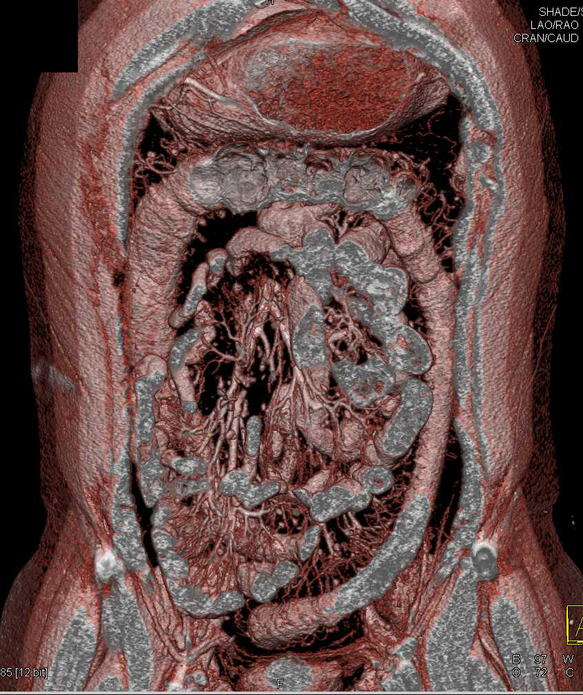 Crohn's Disease Colon and Terminal Ileum - CTisus CT Scan