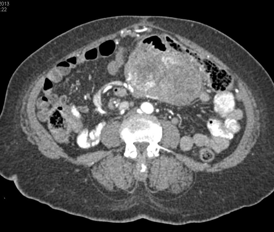 Small Bowel Adenocarcinoma Hard to Differentiate from a GIST Tumor or Lymphoma - CTisus CT Scan