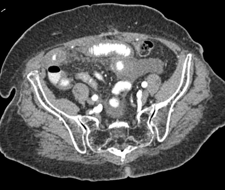 Ischemic Bowel with Peritonitis - CTisus CT Scan