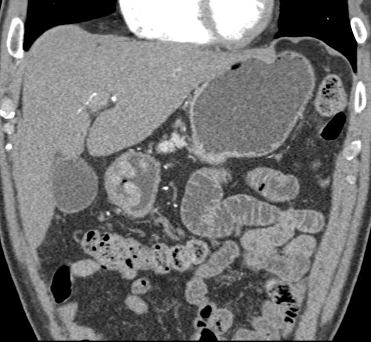 Carcinoma of the Antrum of the Stomach - CTisus CT Scan