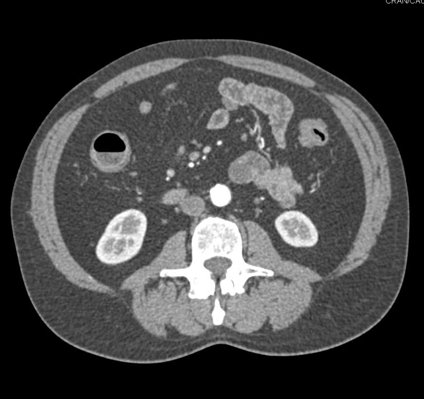 Crohn's Disease with Acute Flare-up and Colon and Small Bowel Involved - CTisus CT Scan