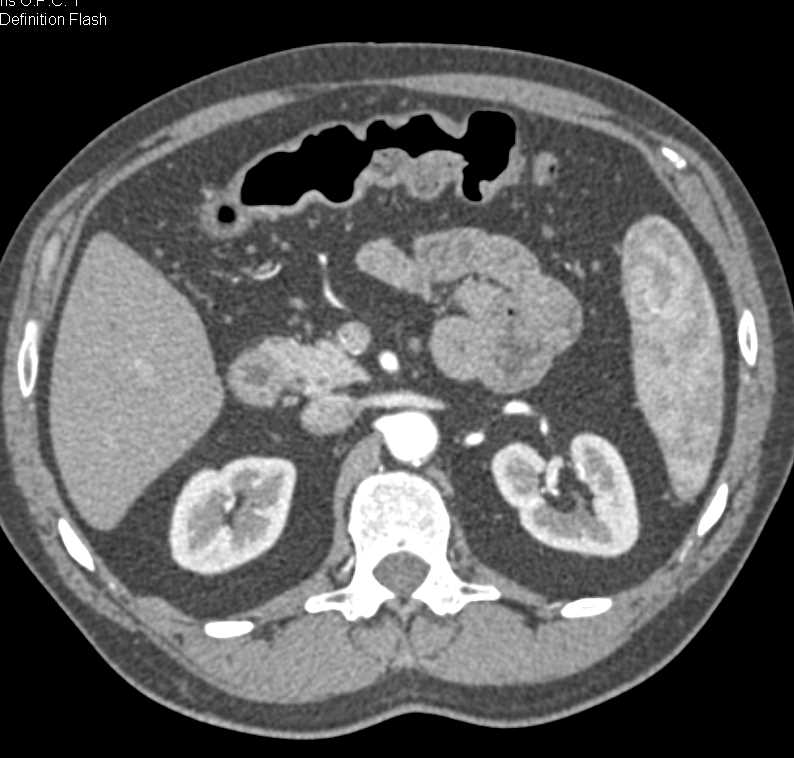 Crohn's Disease with Acute Flare-up and Colon and Small Bowel Involved - CTisus CT Scan