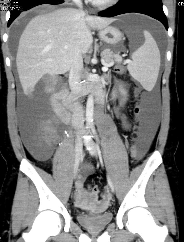 Carcinomatosis with Implants in Abdomen and Pelvis - CTisus CT Scan