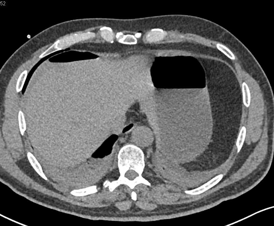 Failed Renal Transplant with Right Lower Quadrant Bleed - CTisus CT Scan