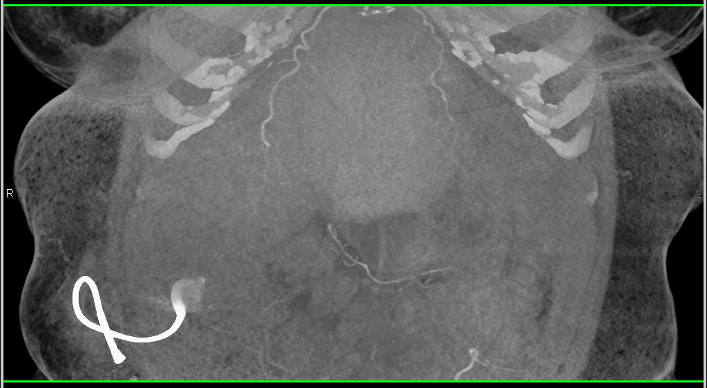 Acute Cholecystitis - CTisus CT Scan