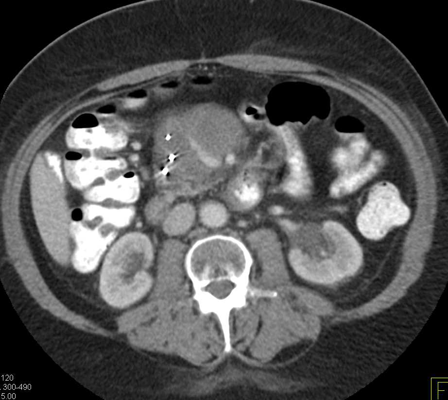 Lymphoma in the Root of the Mesentery - CTisus CT Scan