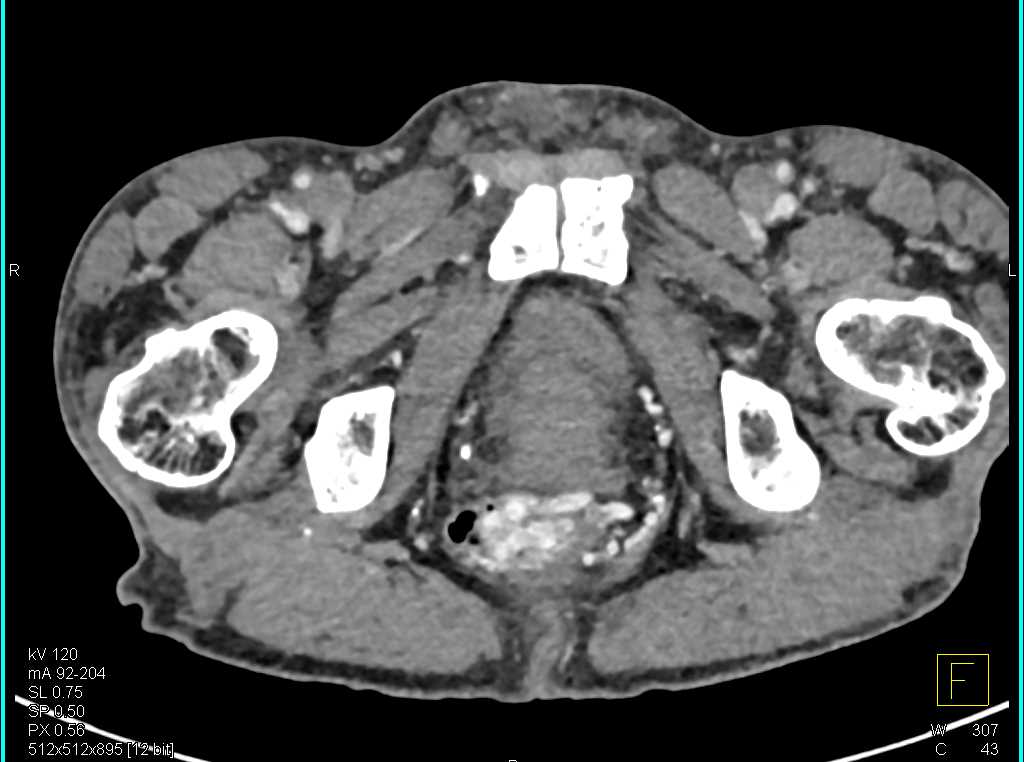 Gastrointestinal (GI) Bleed due to Rectal Varices - CTisus CT Scan