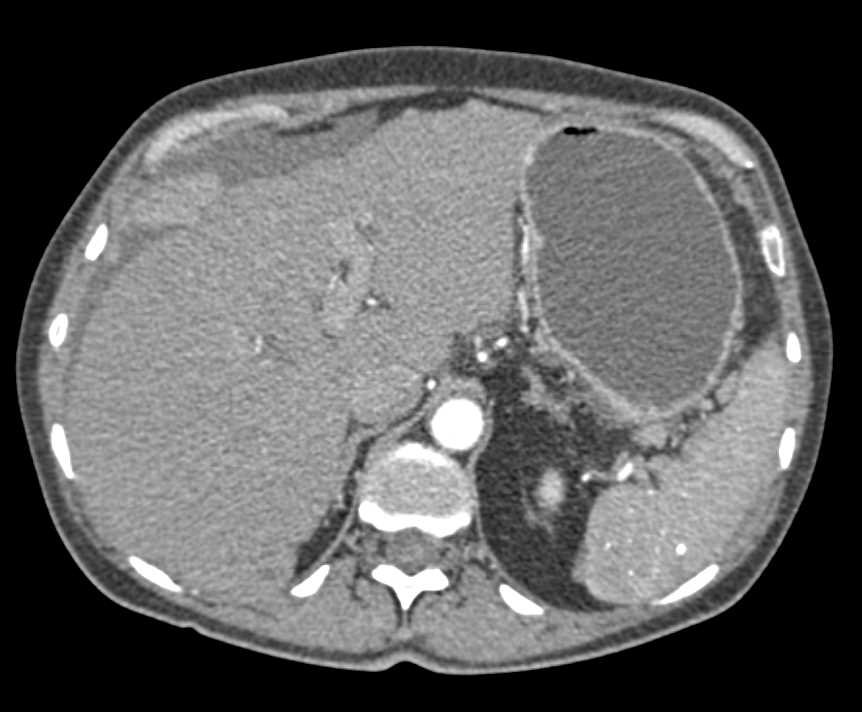 Pseudomyxoma Peritonei (PMP) - CTisus CT Scan