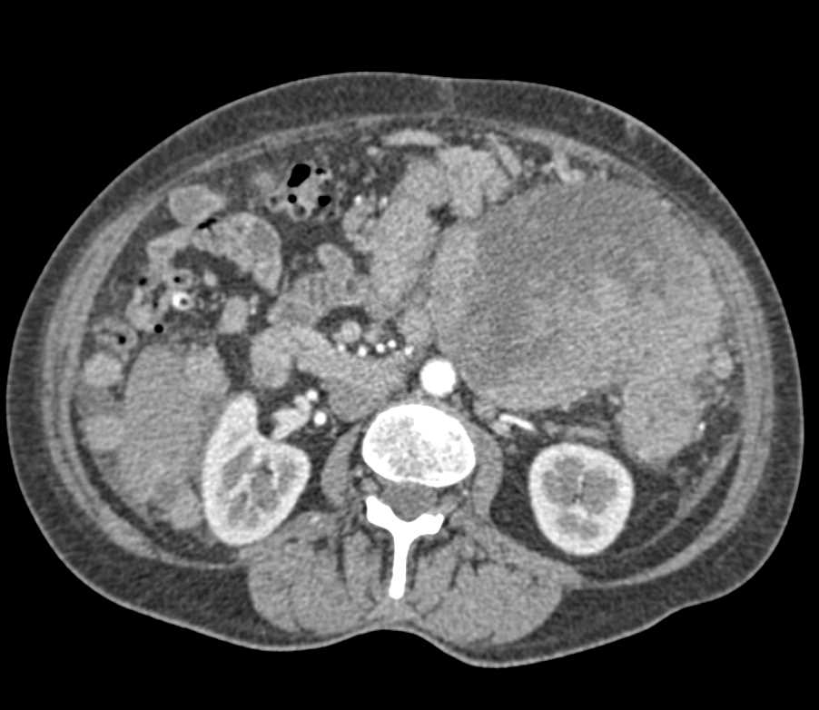 Pseudomyxoma Peritonei (PMP) - CTisus CT Scan