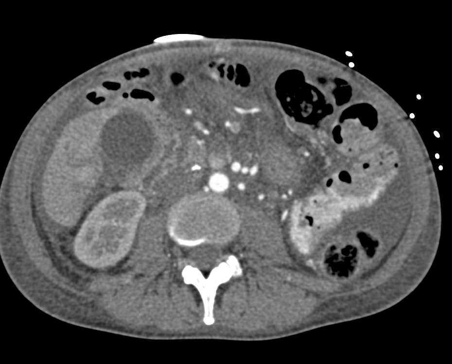 Metastatic Colon Cancer with Liver Metastases and Carcinomatosis - CTisus CT Scan