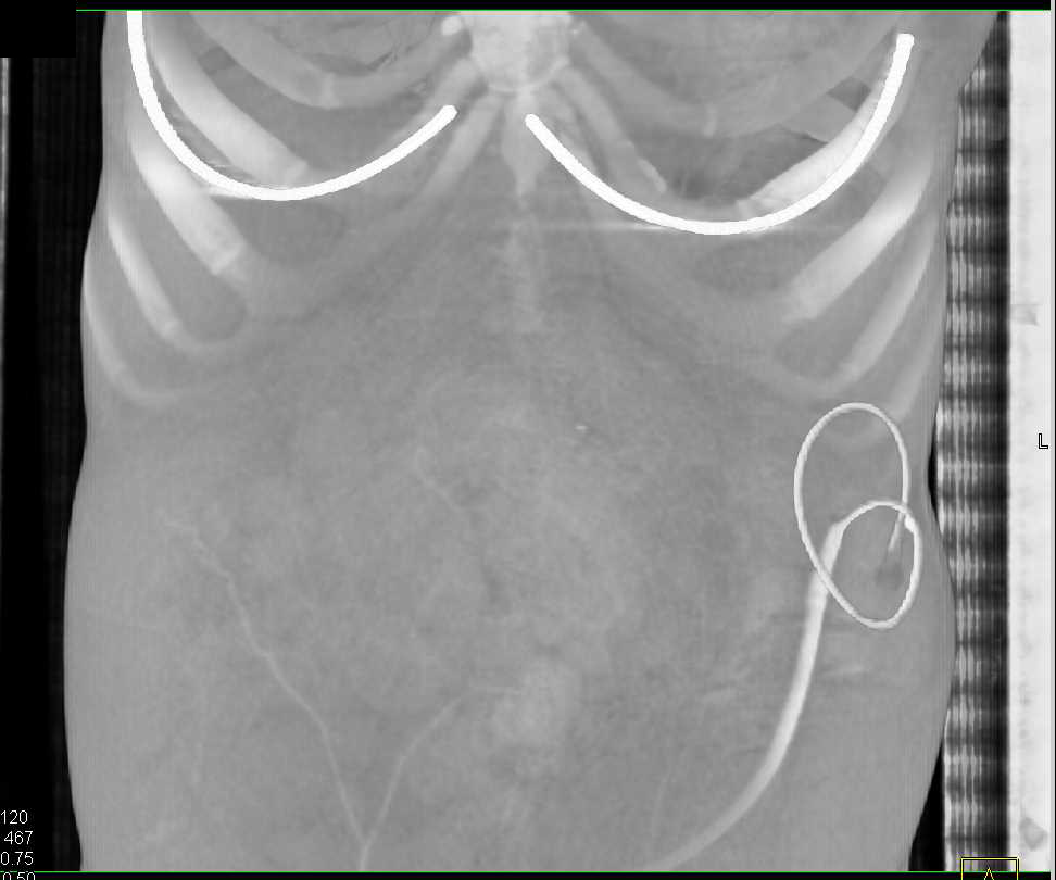 Extensive Tumor Implants Throughout the Abdomen due to GIST Tumor - CTisus CT Scan