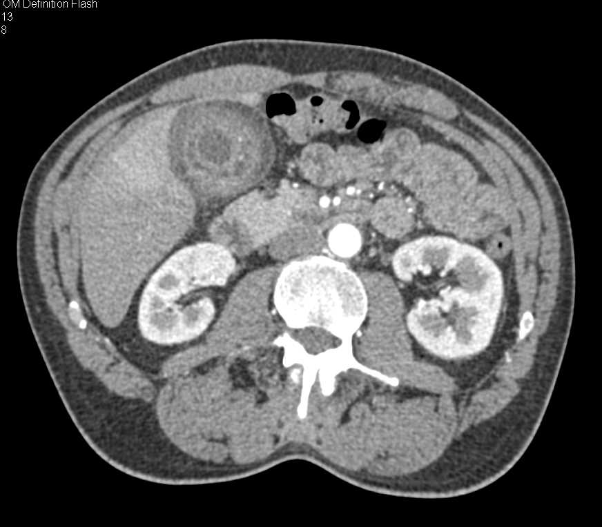 Acute Cholecystitis with Perfusion Changes in Adjacent Liver - CTisus CT Scan