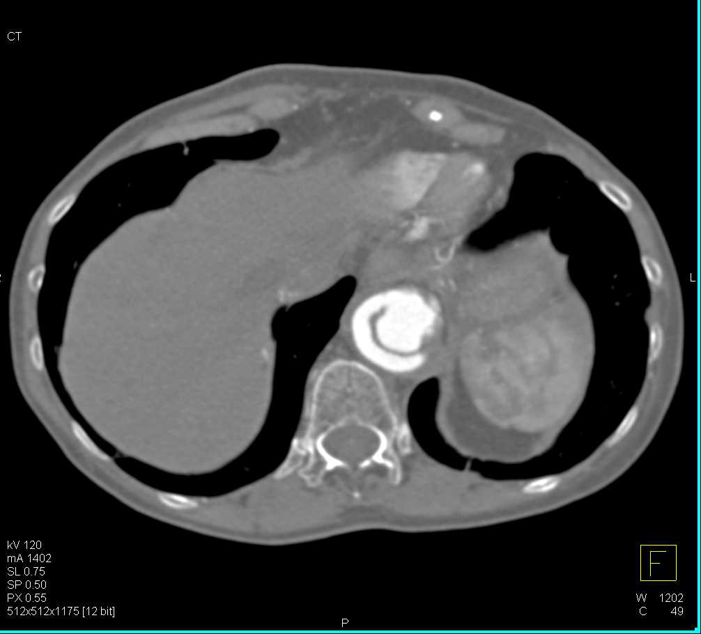 Aortic Aneurysm with Reimplantation of the Celiac and SMA - CTisus CT Scan