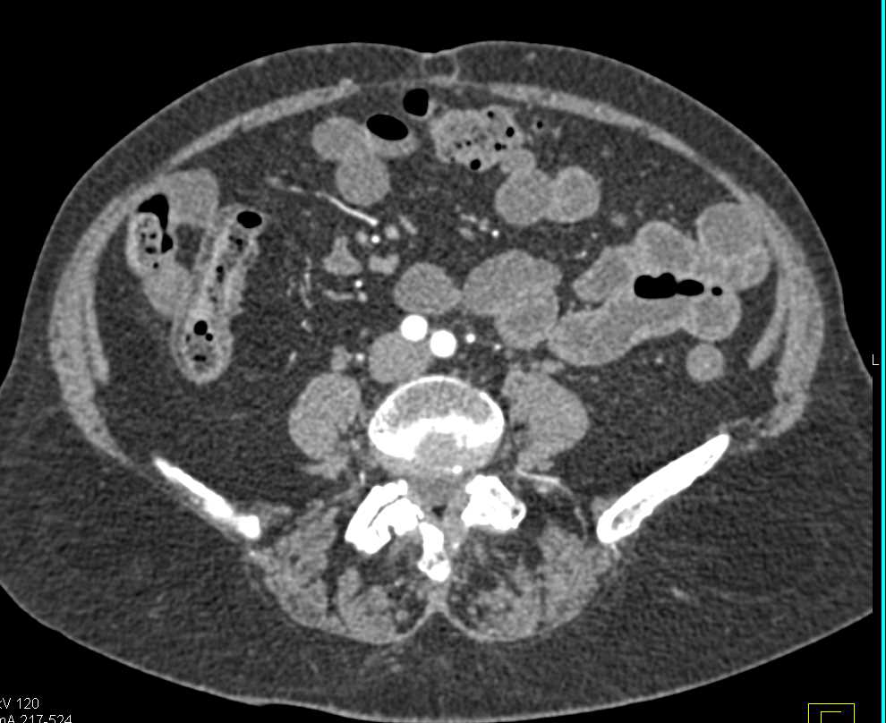 Crohn's Disease Ileum with Comb Sign - CTisus CT Scan