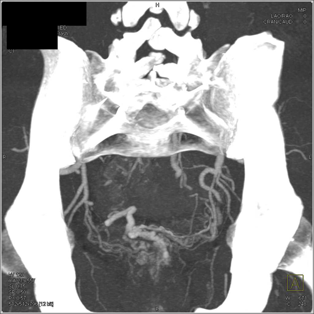 Rectal Varices - CTisus CT Scan