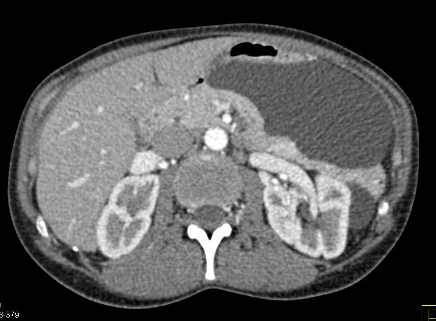 Lymphocele in Left Upper Quadrant - CTisus CT Scan