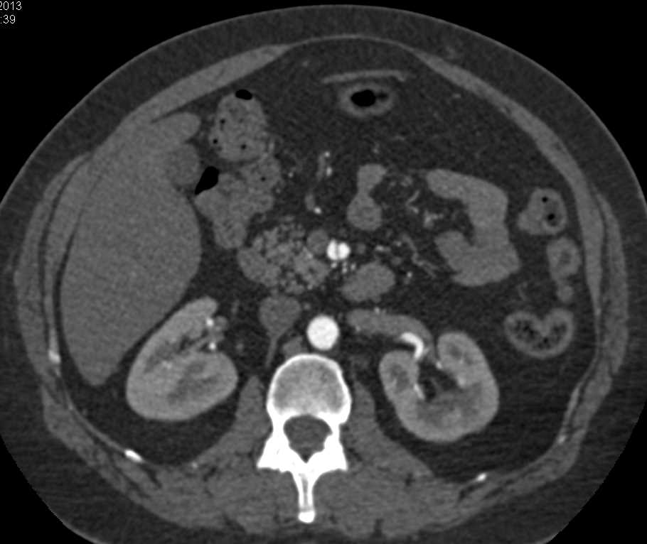 Incidental Dissection of the SMA - CTisus CT Scan