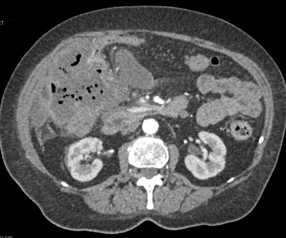 Perforated Gallbladder with a Large Abscess - CTisus CT Scan