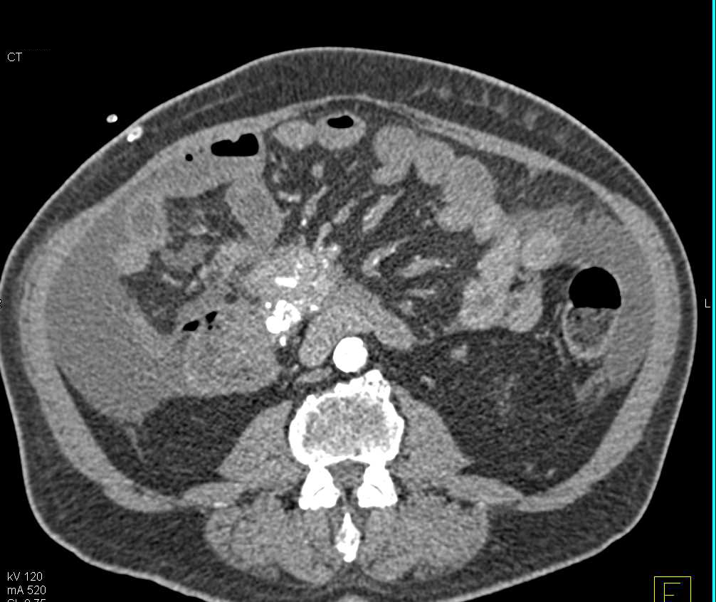 Carcinoid Tumor in the Root of the Mesentery with Calcification and Encases Superior Mesenteric Artery (SMA) and Superior Mesenteric Vein (SMV) - CTisus CT Scan