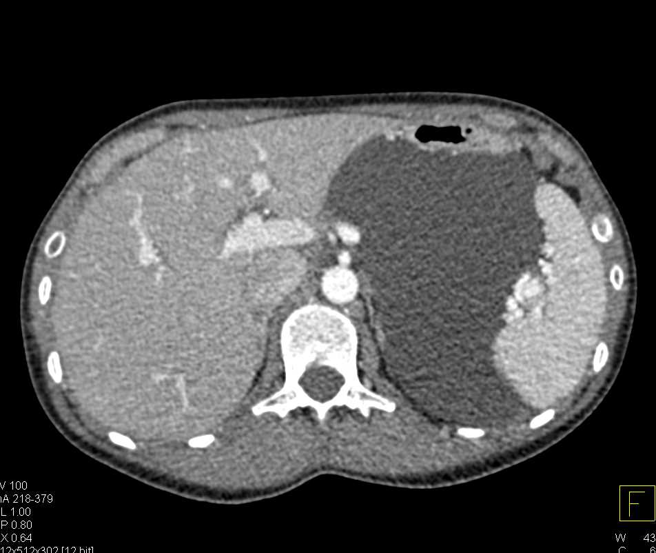 Lymphangioma in Left Upper Quadrant - CTisus CT Scan