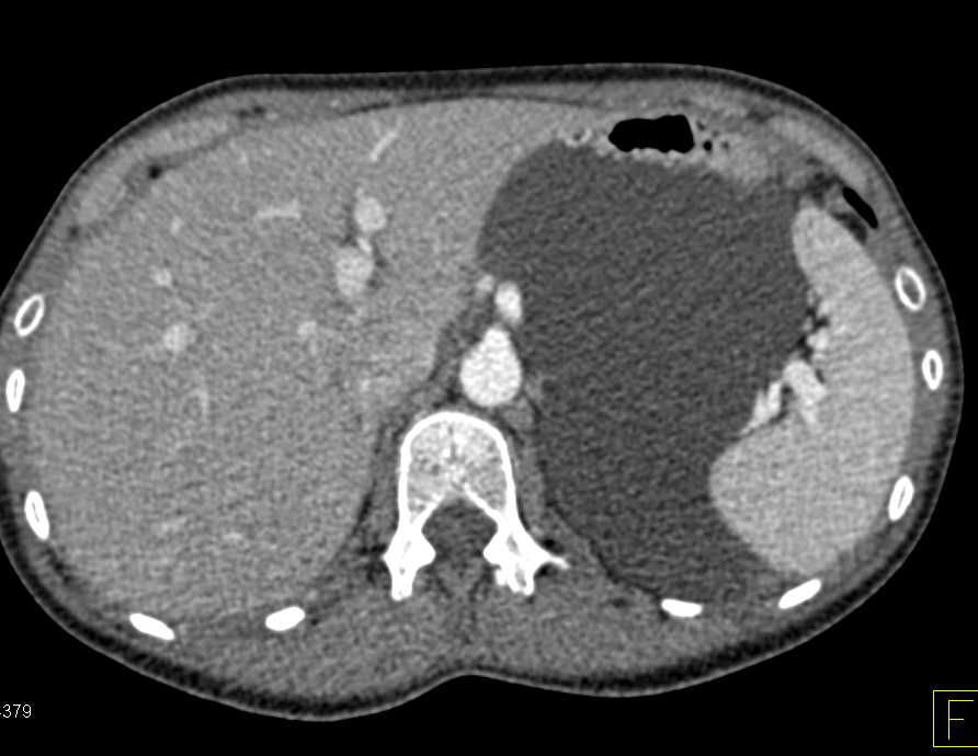 Lymphangioma in Left Upper Quadrant - CTisus CT Scan