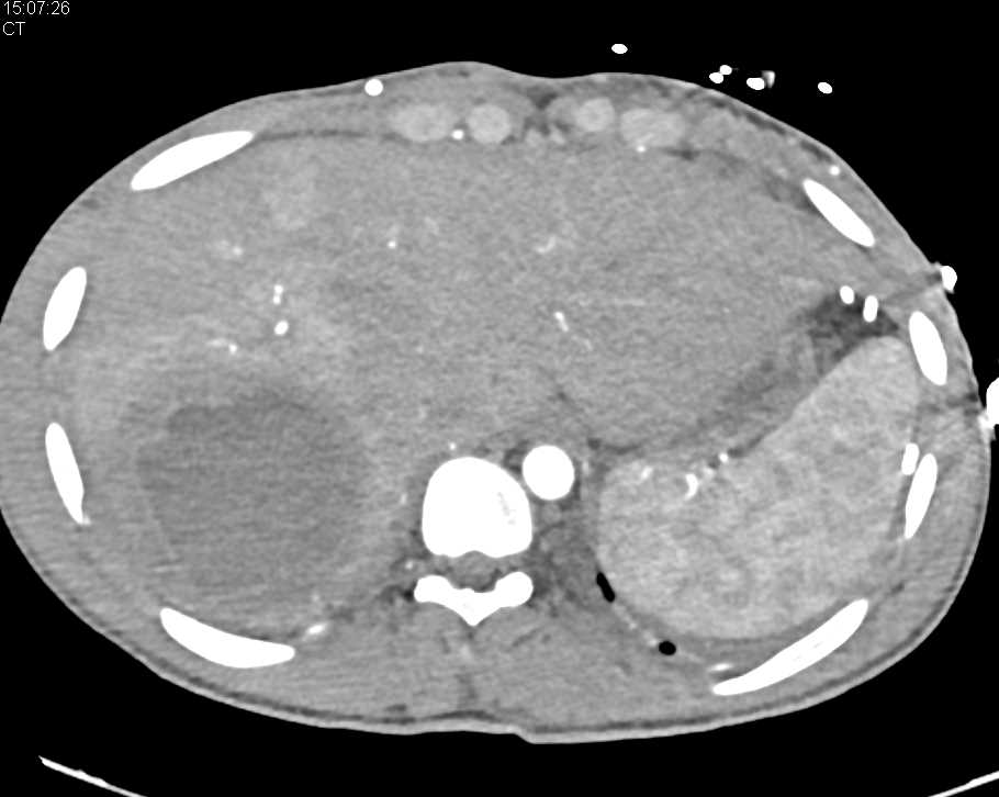 Liver Abscess - CTisus CT Scan