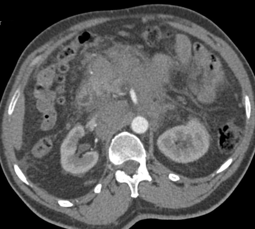 Lymphoma with Infiltration of the Mesentery and the Pancreas - CTisus CT Scan