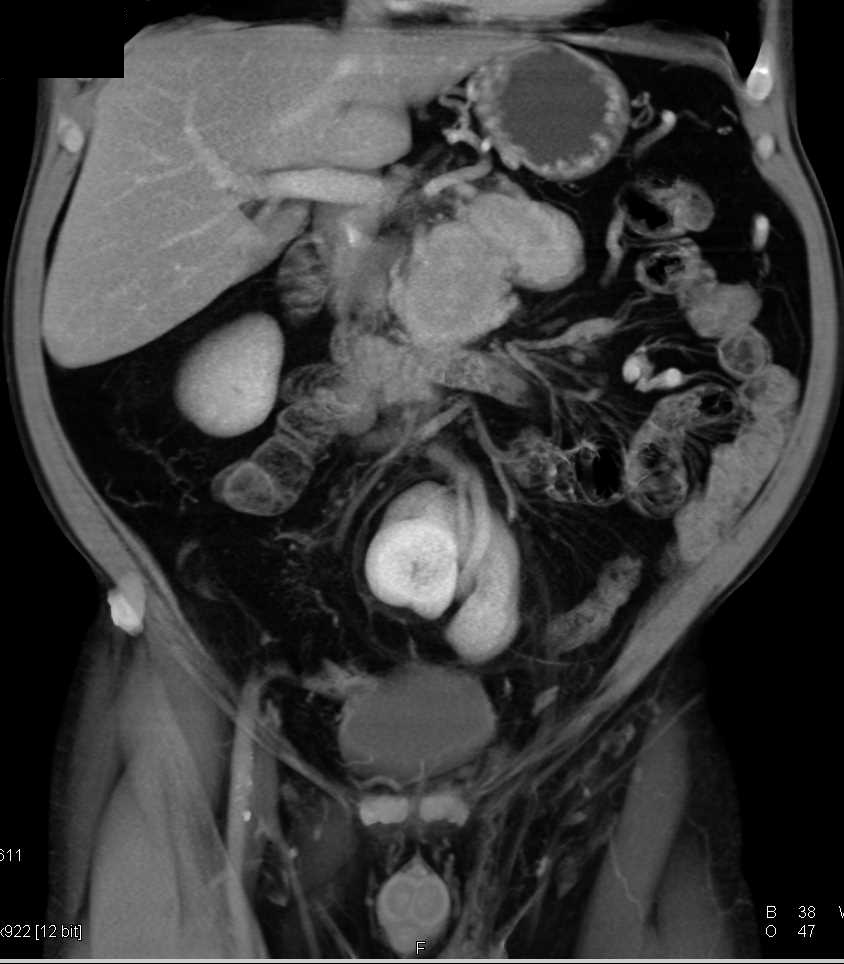 Lymphoma with Extensive Adenopathy - CTisus CT Scan