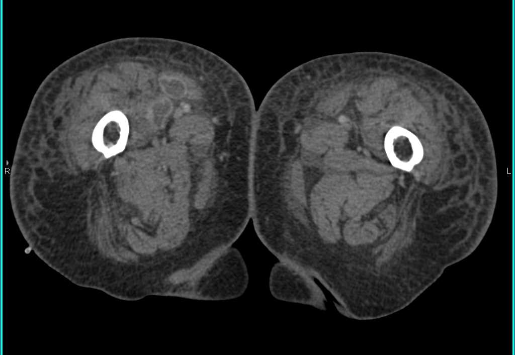 Abscess Track into the Right Thigh - CTisus CT Scan