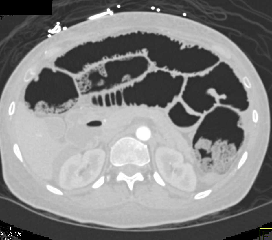 Pneumatosis with Ischemic Bowel due to Superior Mesenteric Artery (SMA) Occlusion - CTisus CT Scan