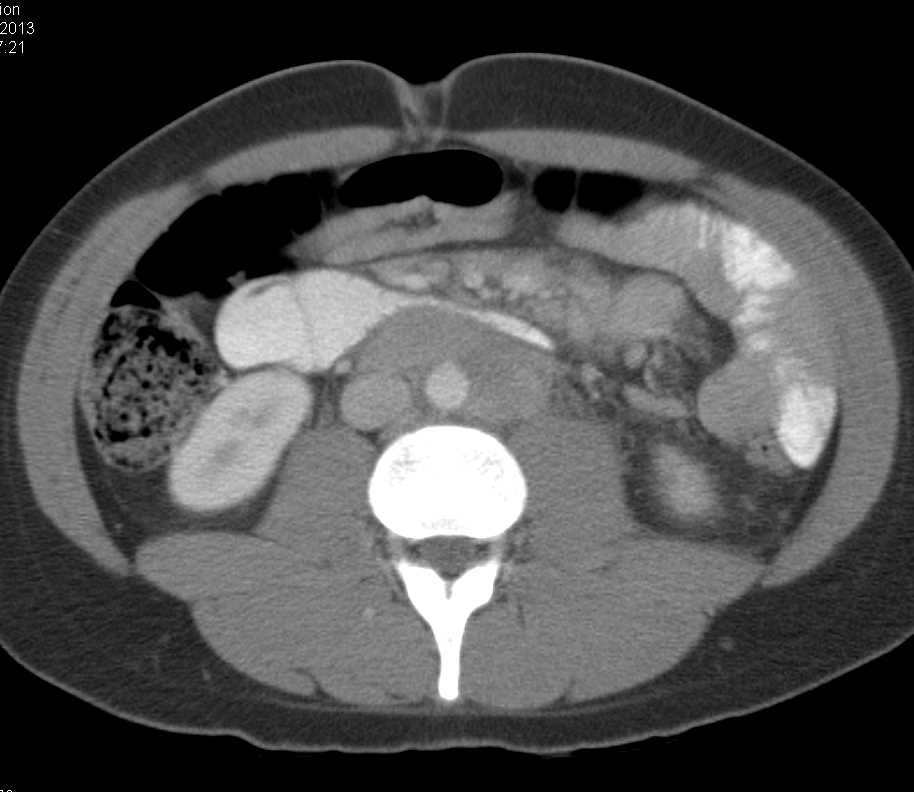 Tumor Infiltration into the Mesentery with Carcinomatosis and Rectal Cancer - CTisus CT Scan