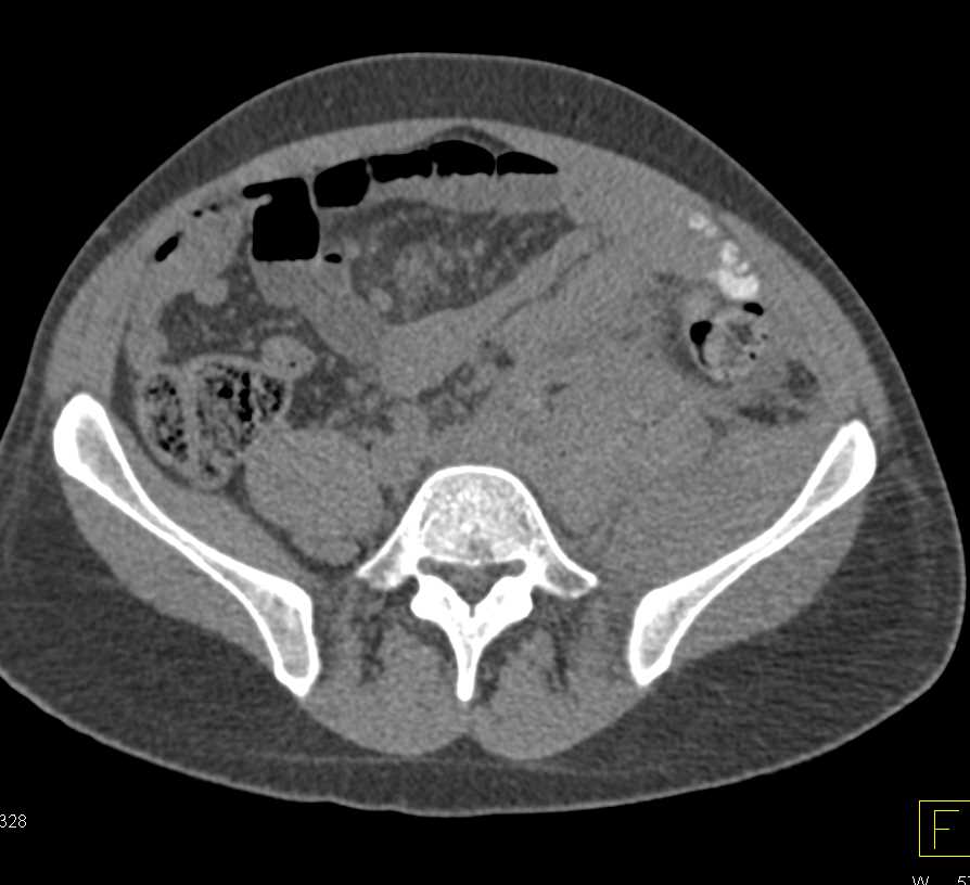 B Cell Lymphoma with Bulky Adenopathy - CTisus CT Scan