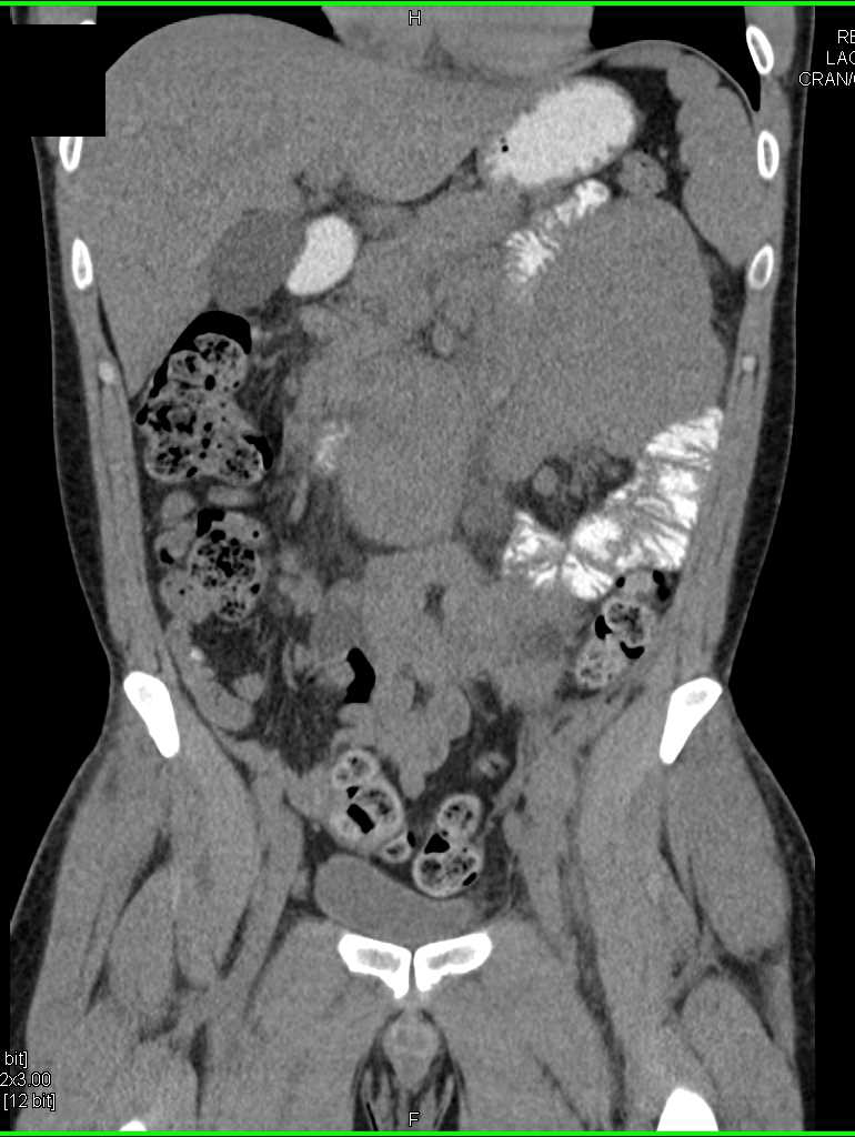 B Cell Lymphoma with Bulky Adenopathy and Colon Involvement - CTisus CT Scan