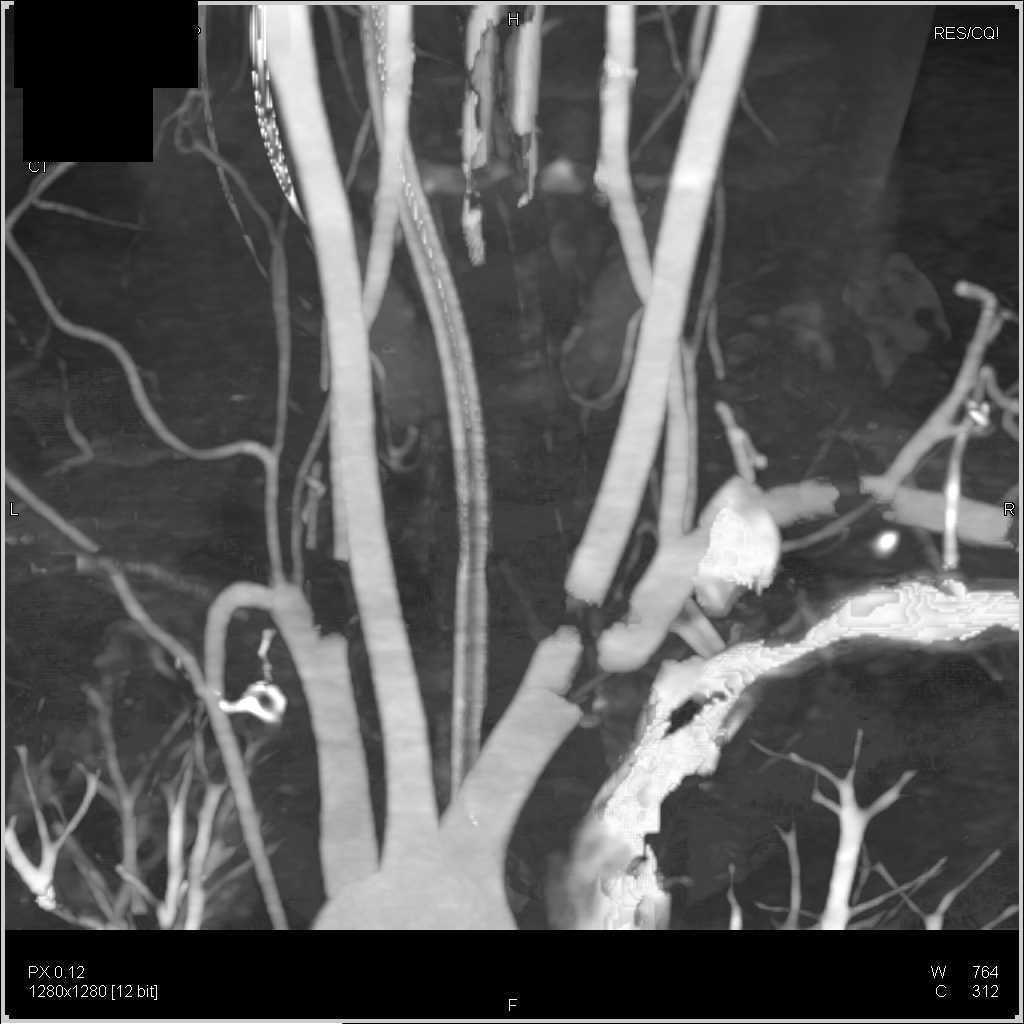 Pneumoperitoneum in a Patient with Vasculitis - CTisus CT Scan