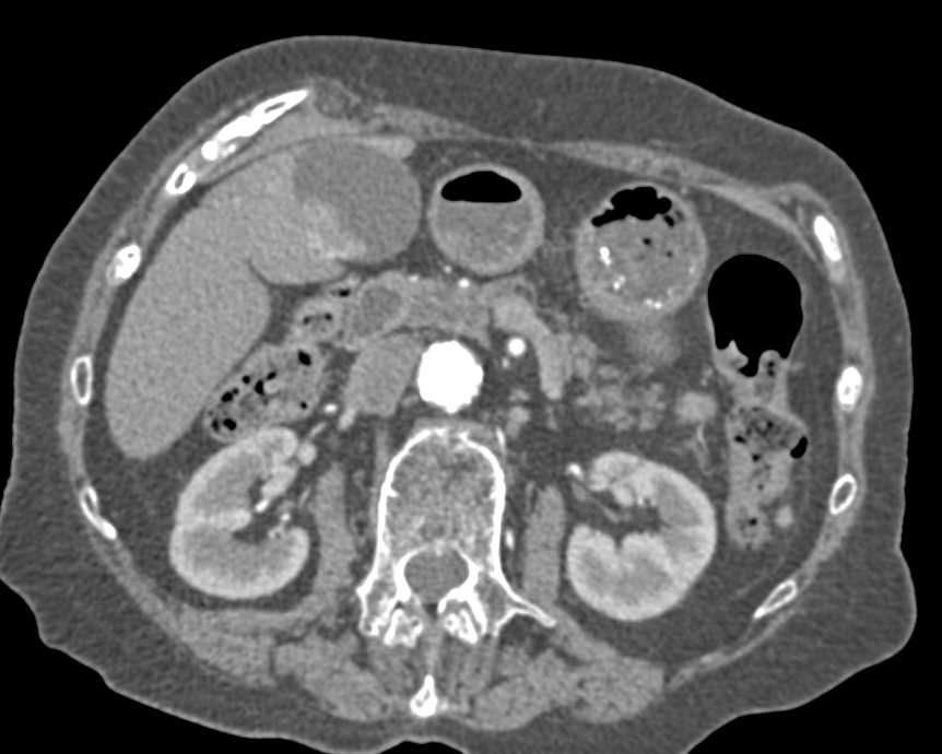 Incidental Polypoid Mass in Gallbladder was a Carcinoma - CTisus CT Scan