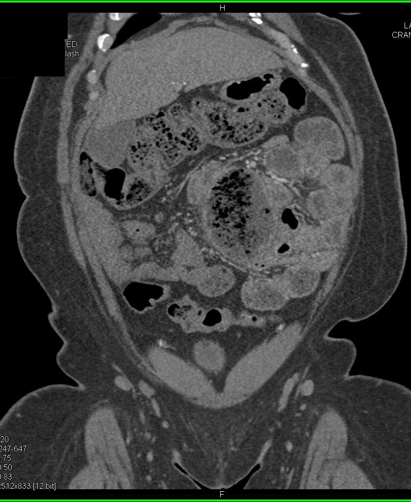 Bowel Obstruction with Feces Sign - CTisus CT Scan