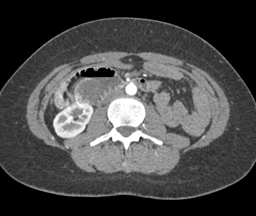 Small Bowel Obstruction (SBO) with Feces Sign with Obstruction Near the Osteomy - CTisus CT Scan