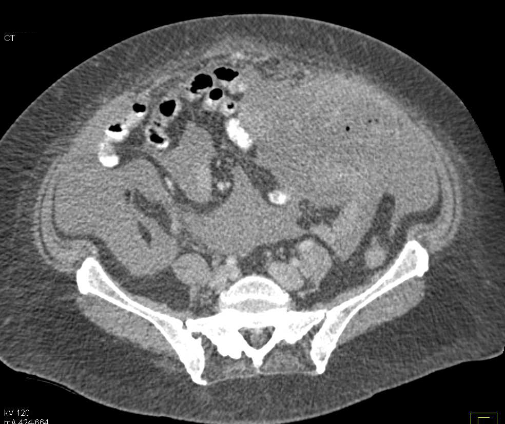 Carcinomatosis due to a GI Primary - CTisus CT Scan