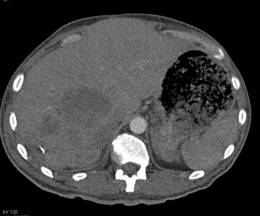 Large Ulcerating GIST Tumor with Liver Metastases - CTisus CT Scan