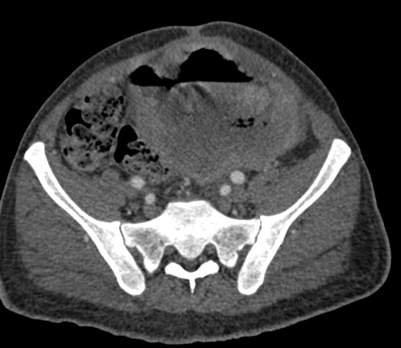 Large Ulcerating GIST Tumor with Liver Metastases - CTisus CT Scan