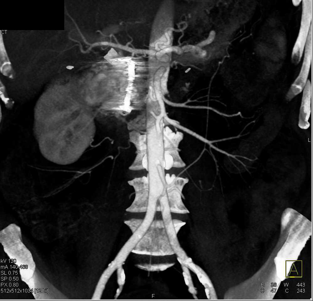 Active Bleed Around Head of the Pancreas with Prior Coiling - CTisus CT Scan