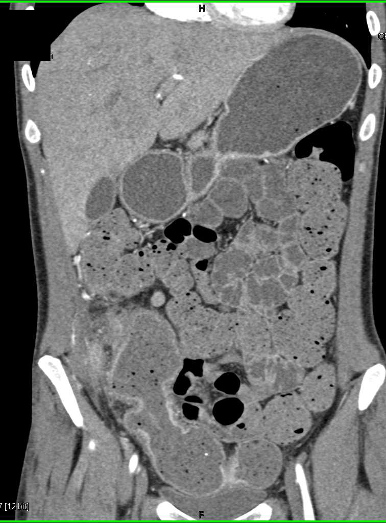 Crohn's Disease Involves the Terminal Ileum and Cecum - CTisus CT Scan