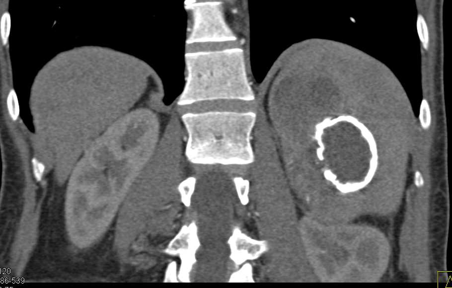 Splenic Hematoma that Has Calcified - CTisus CT Scan