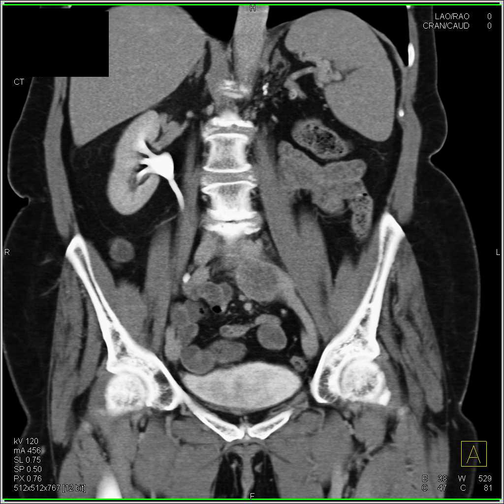 Adenopathy at Left Iliac Bifurcation - CTisus CT Scan