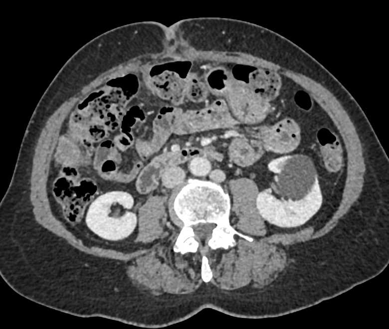 Omental Implants in Right Lower Quadrant - CTisus CT Scan