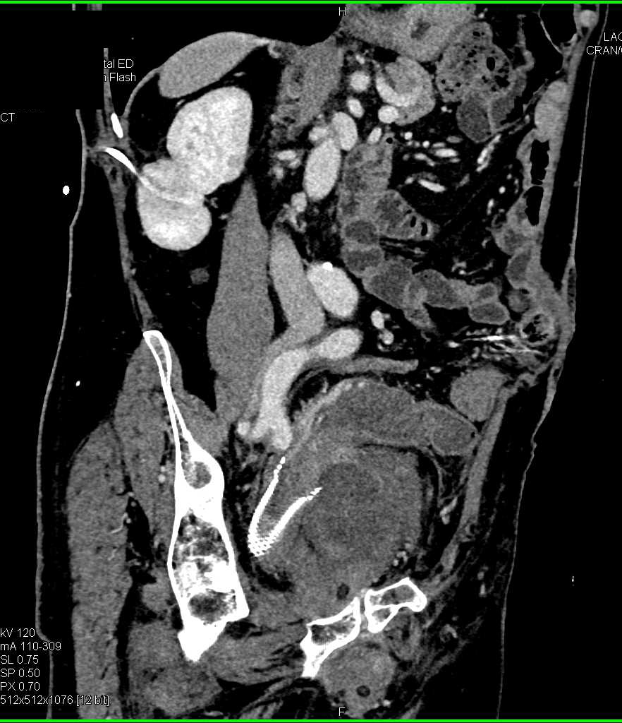 Stent in Rectum with Bulky Invasive Rectal Cancer Invades Pelvis - CTisus CT Scan