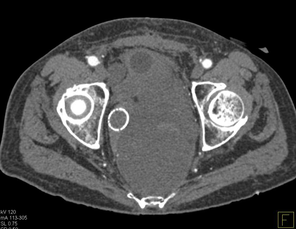 Stent in Rectum with Bulky Invasive Rectal Cancer Invades Pelvis - CTisus CT Scan